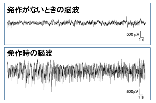 PV陽性抑制性神経細胞でNav1.1を減らしたときのマウスの脳波の図