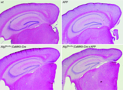 Picture show how amyloidosis exacerbates neurodegeneration