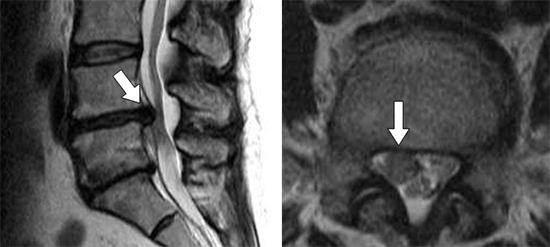 腰椎椎間板ヘルニアのMRI写真の図