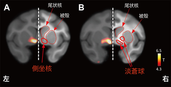 ケタミン投与によりセロトニン1B受容体の有意な結合上昇が認められた部位の画像