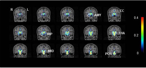 PET imaging of neuroinflammation in chronic fatigue syndrome
