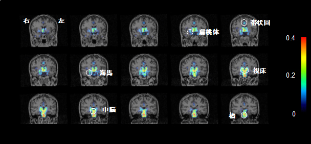 慢性疲労症候群/筋痛性脳脊髄炎の患者における脳内炎症の図