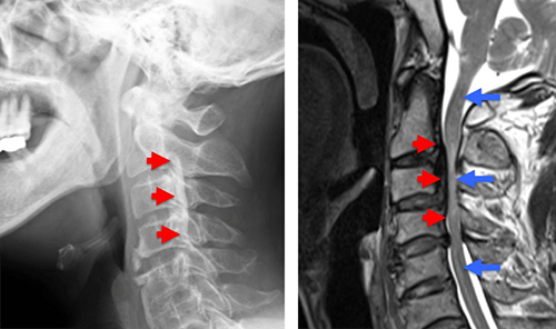 後縦靭帯骨化症（OPLL）患者の写真の画像