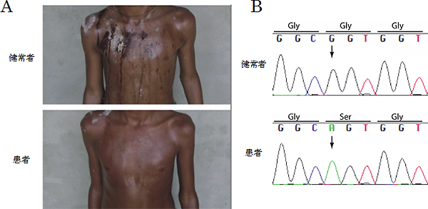 患者の発汗の様子とDNAの変異の図