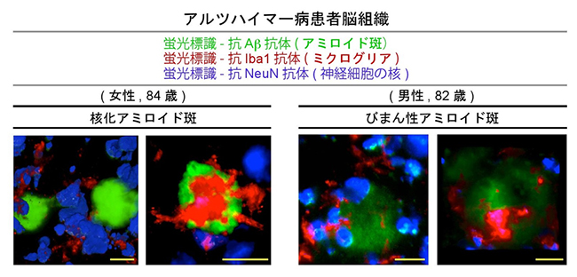 ヒト死後脳における核化アミロイド斑とびまん性アミロイド斑の図