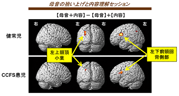 二重課題遂行中でより活性化する脳部位の図