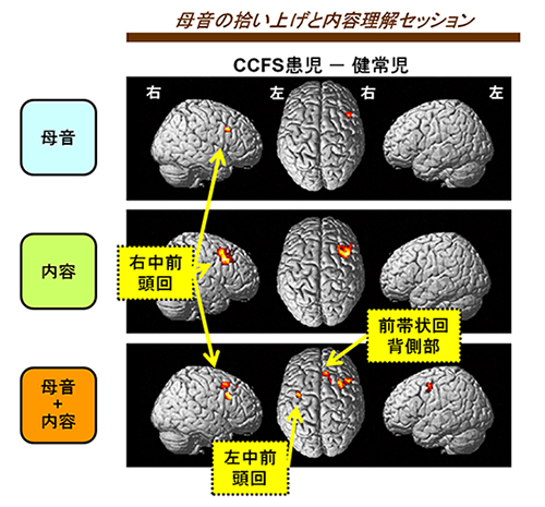 課題遂行中にCCFS患児でより活性化する脳部位の図