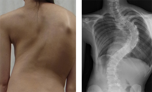 思春期特発性側彎症 Ais 発症に関連する遺伝子 Bnc2 を発見 理化学研究所