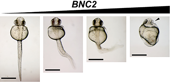 BNC2の過剰発現とゼブラフィッシュでの側弯症の発生の図