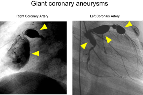 photos of coronary aneurysms in Kawasaki disease