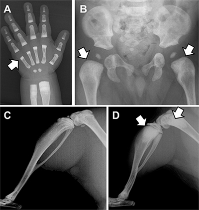骨硬化性骨幹端異形成症とLRRK1ノックアウトマウスのＸ線像の画像