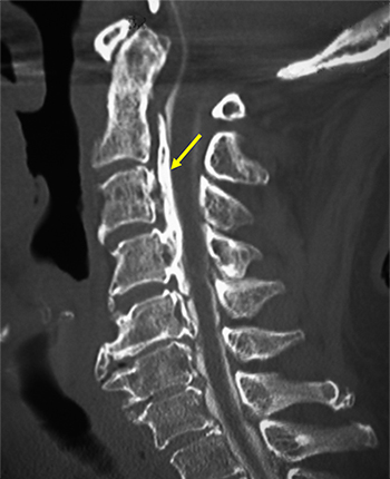 後縦靭帯骨化症（OPLL）患者のCT画像の図
