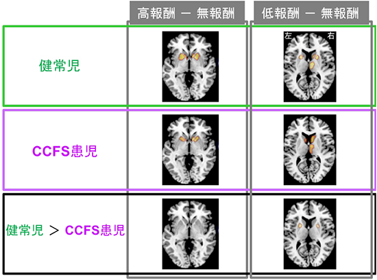 高報酬獲得時（左）と低報酬獲得時（右）の線条体（尾状核と被殻）の活性化の図