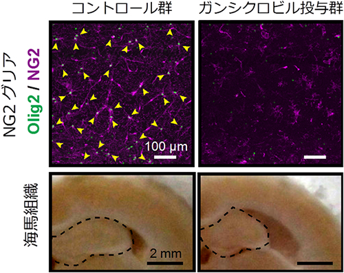 中枢神経前駆細胞（NG2グリア）除去による海馬組織への影響の図