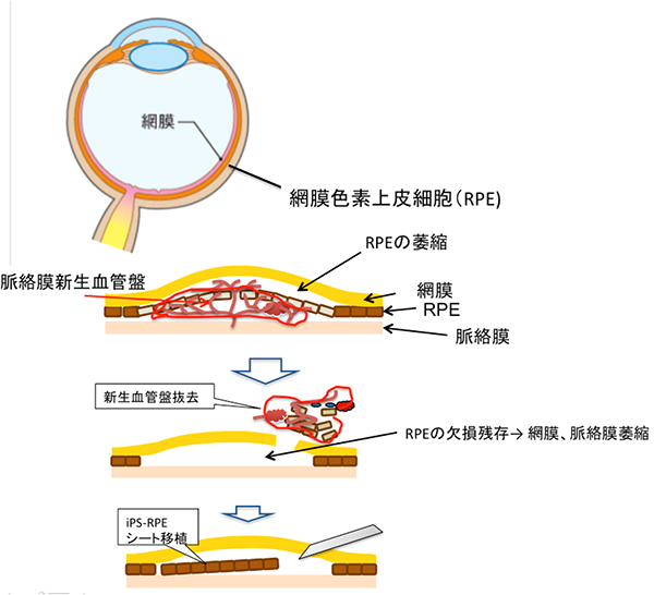 滲出型加齢黄斑変性の病変と新生血管盤去手術、iPS細胞を用いた本研究の治療デザインの図