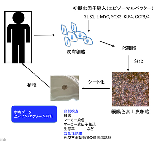 自己iPS細胞由来網膜色素上皮細胞（iPS-RPE）作製と移植治療までの流れの図