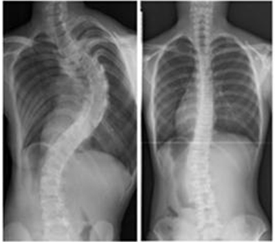 側彎症の進行例と非進行例の図