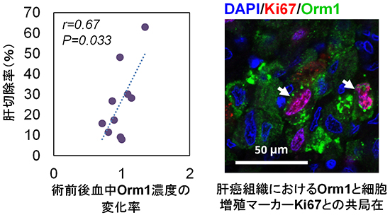 肝がん患者における肝切除術前後の血中Orm1濃度変化および肝がん組織中のOrm1発現の図