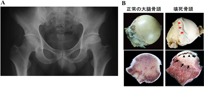 特発性大腿骨頭壊死症（ION）の病像の図