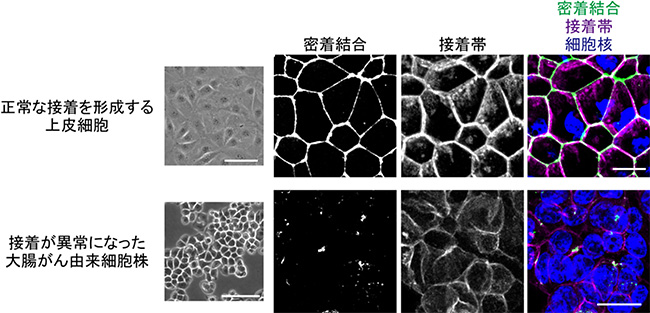 大腸がん由来細胞における接着異常の図