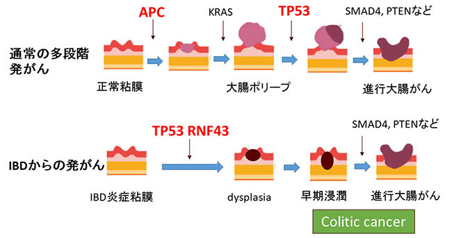 通常型の大腸がんとcolitic cancerの多段階発がん経路の図