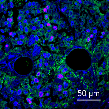 がん遺伝子MYCNを発現する肝がん幹細胞の蛍光免疫染色像の画像