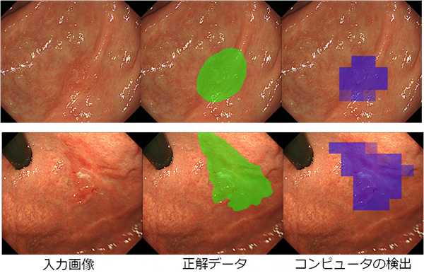 医師の診断（緑）とコンピュータの自動検出（紫）が示した早期胃がんの領域の写真