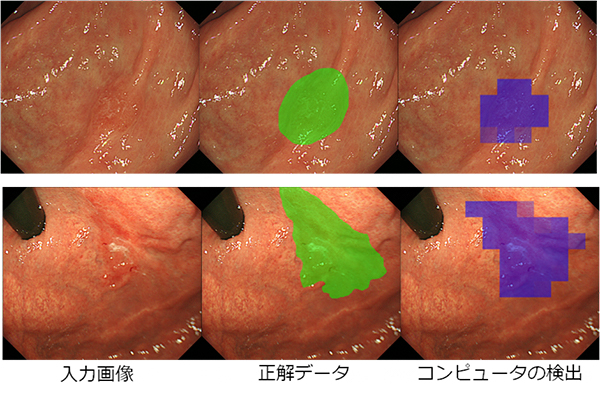 AIで早期胃がん領域の高精度検出に成功～早期発見・領域検出で早期治療に大きく貢献～