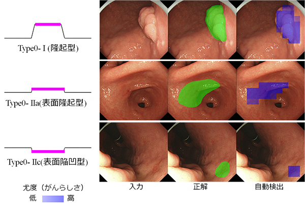 タイプ別の早期胃がんの自動検出例の写真