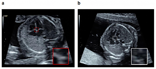 物体検知技術を活用した胎児心室中隔の異常検知例の図