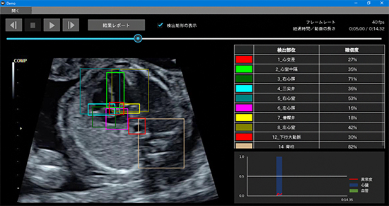 今回開発した、胎児心臓超音波スクリーニング異常検知システムの図