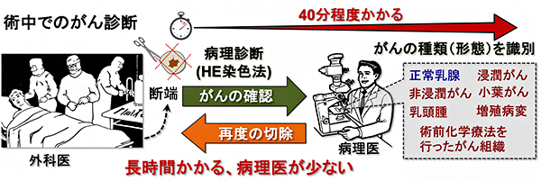 乳がんの術中診断に用いられている病理学的診断(HE染色法)の図
