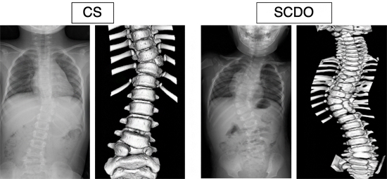先天性側弯症（CS）と脊椎肋骨異形成症（SCDO）のX線像と3次元CT像の図