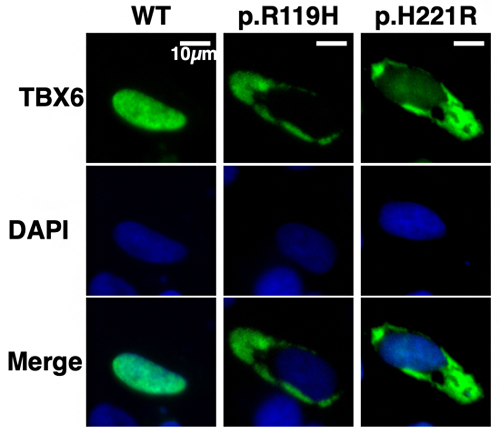 TBX6遺伝子のミスセンス変異によるTBX6タンパク質の細胞内局在異常の図