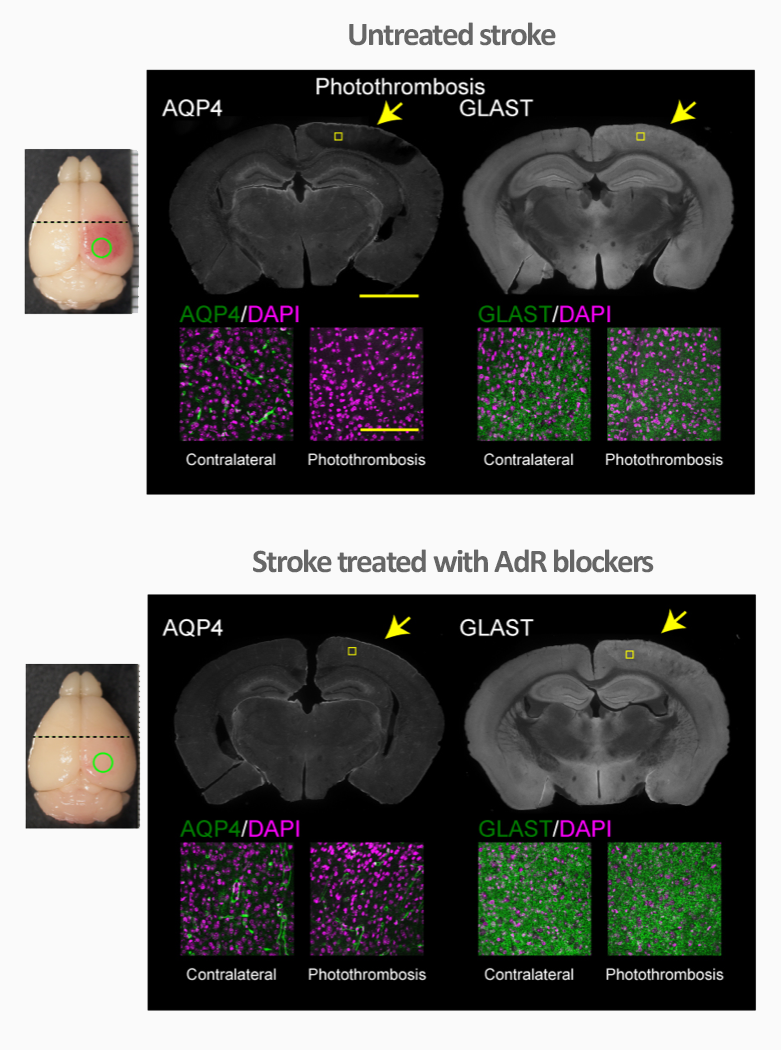 AdR blockers protect against stroke