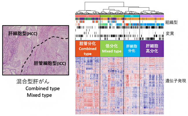 肝がんの新しい分化分子分類と診断マーカー～日中共同による混合型肝がんのゲノム解析～