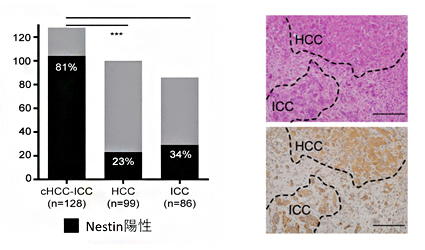 Nestinは混合型肝がんの診断マーカーの図
