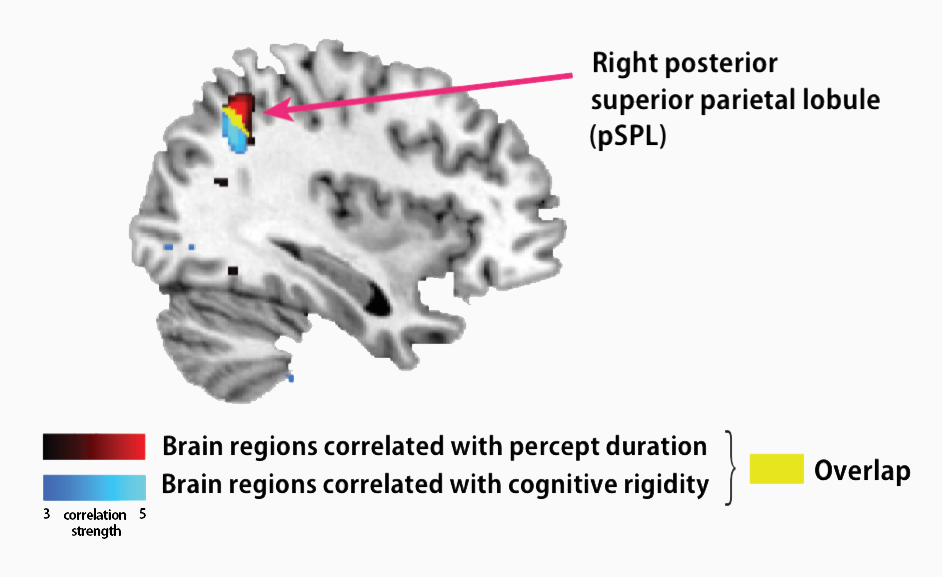 pSPL correlates with symptoms in autism