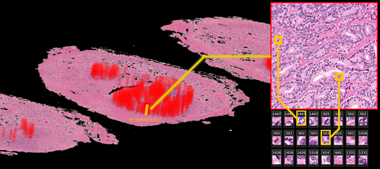 前立腺病理標本の連続切片に対する3D病理画像の図