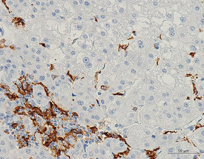 肝臓がん内の腫瘍関連マクロファージM2細胞の図