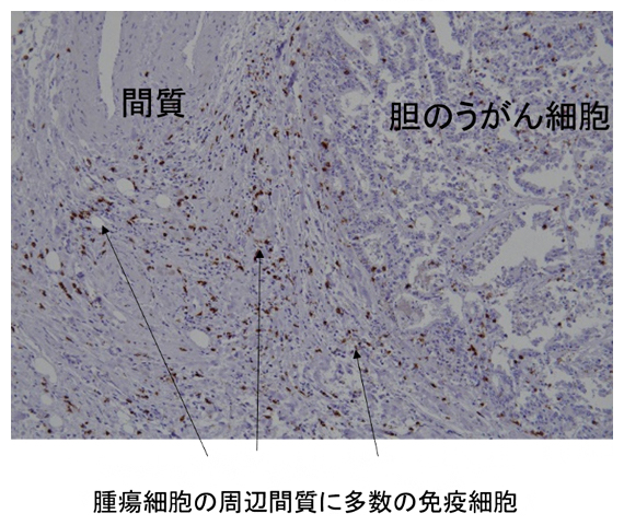 胆脳がんB群の免疫組織染色画像の図
