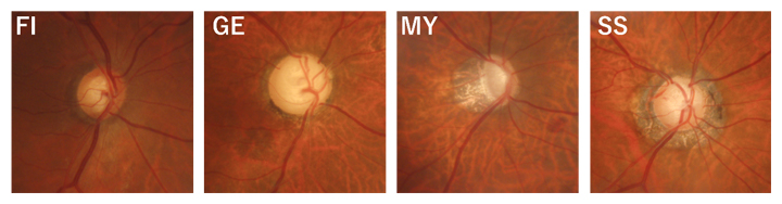 視神経乳頭形状分類（ニコレラ分類）の図