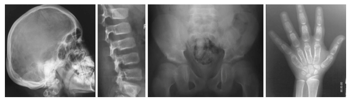 新たなタイプの骨の難病、Ikegawa型頭蓋管状骨異形成症のレントゲン像の図