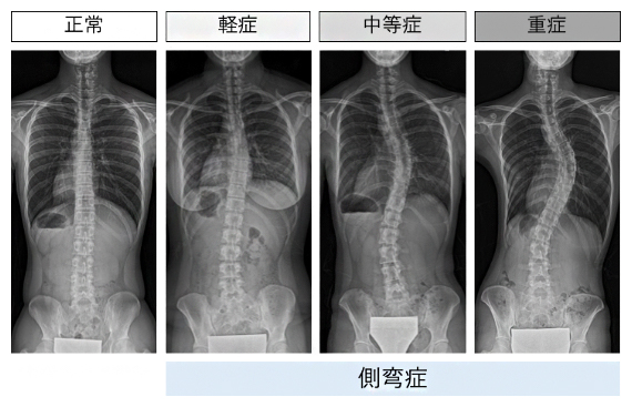 思春期特発性側弯症のX線写真の図