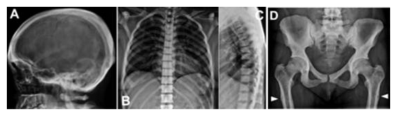 頭蓋骨、脊椎、骨盤、大腿骨の骨濃度の増加が見られる、Ikegawa型大理石骨病患者のX線像の図