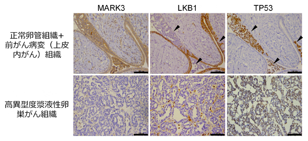 卵巣がん組織におけるLKB1とMARK3のタンパク質発現プロファイルの図