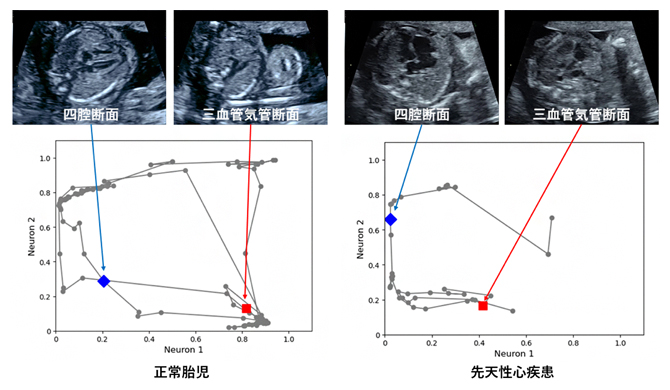 胎児心臓超音波スクリーニング動画へのグラフチャート図の適用の図