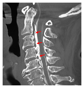 頚椎（背骨の首の部分）を側面から見た後縦靭帯骨化症のCT像の図