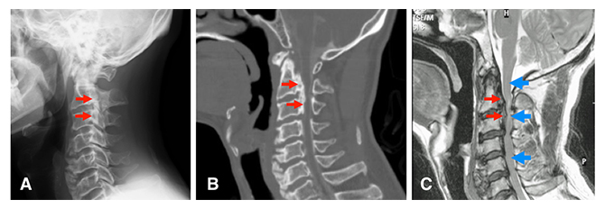 後縦靭帯骨化症（OPLL）の画像所見の図