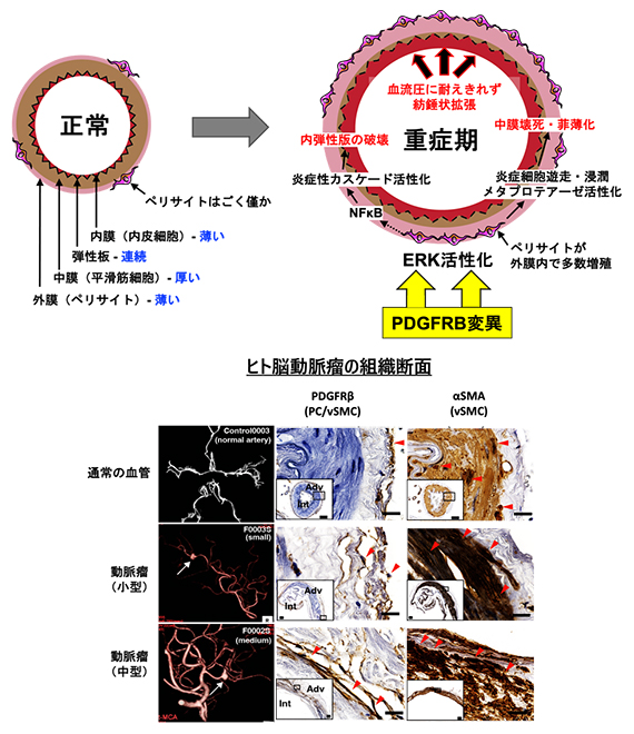 変異陽性動脈瘤のPDGFRβの発現亢進の図